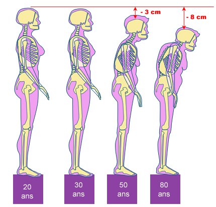 capital osseux de 20 à 80 ans