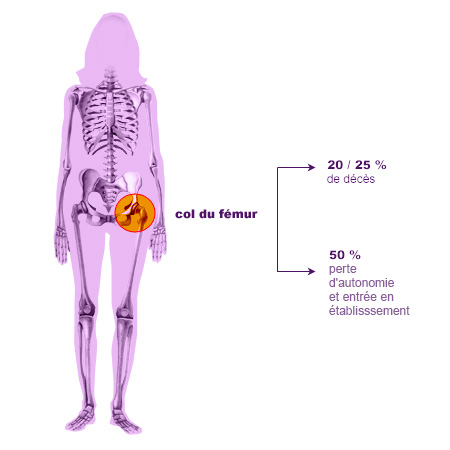 Ostéoporose : comprendre l'anatomie des os