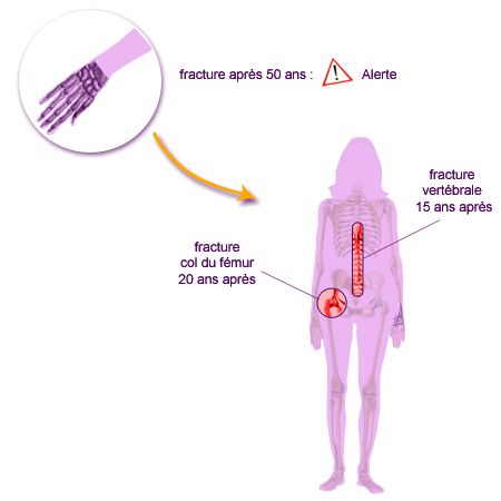 Diagnostic de l'ostéoporose - Mon Ostéoporose