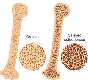 Comparaison de l'os entre individu sain et malade