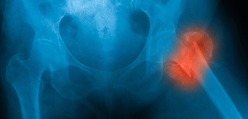 fractures de la hanche