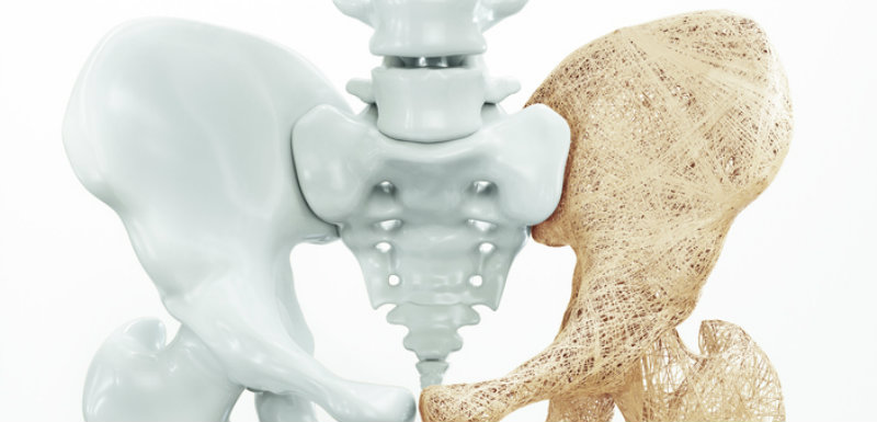 Attention à l’ostéoporose induite par les corticoïdes