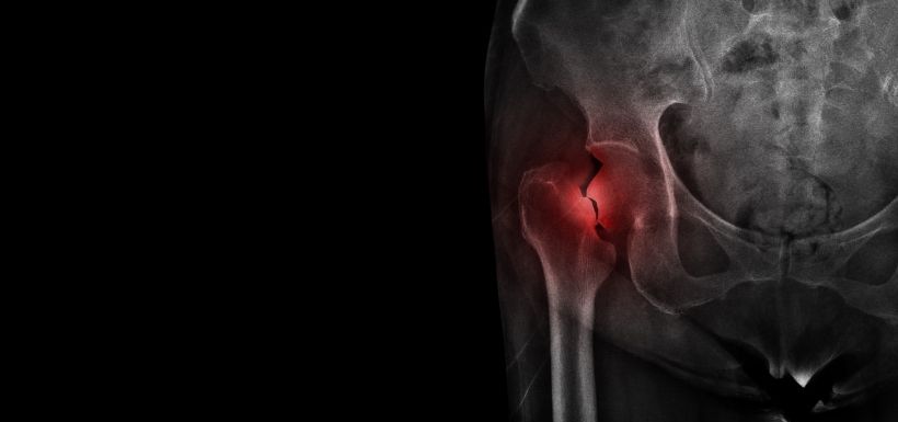 Traiter tous les patients après une fracture liée à l’ostéoporose ? Traiter tous les patients après une fracture liée à l’ostéoporose ?